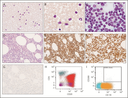 Figure 1. Morphologic and immunophenotypic evaluation. (A-B) Low (original magnification ×400) and high (original magnification ×1000) magnification of Wright-Giemsa stained peripheral blood smear show circulating small lymphocytes, some of which contain cytoplasmic vacuoles. (C) Wright-Giemsa stained bone marrow aspirate smear at high (original magnification ×1000) magnification shows similar small lymphocytes with cytoplasmic vacuoles. (D) Hematoxylin and eosin–stained bone marrow biopsy (original magnification ×400) shows extensive infiltration with small lymphocytes. (E-G) Immunohistochemical stains indicate that lymphocytes are positive for CD20 (E) and cyclin D1 (F) but are negative for SOX11 (G). (H-I) Immunophenotyping by flow cytometry demonstrates λ light chain–restricted B lymphocytes are positive for CD20 (red) and CD19 (orange), partially positive for CD5, and negative for CD200.