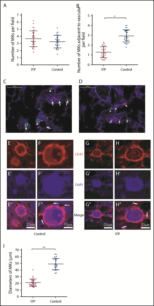 Figure 1. Reduced platelet production and impaired MK distribution and maturation. Scatter dot plots show the total number of MKs per low-power field (A) and the number of MKs adjacent to the vasculature in each low-power field (B) in the ITP group (n = 30) and control group (n = 28). (C) Representative graph of BM stained with anti-CD31 (red), anti-CD41 (green), and DAPI (blue) showing the distribution of vascular cells and MKs in the BM niche in the control group (scale bar, 100 μm). (D) Representative graph of BM stained with anti-CD31 (red), anti-CD41 (green), and DAPI (blue) showing the distribution of vascular cells and MKs in the BM niche in the ITP group (scale bar, 100 μm). Arrowheads in panels C-D indicate MKs near the sinusoids in the BM. Arrows in panels C-D indicate the endothelial cells in the BM. (E-E″) Representative graph of MKs in the vascular niche of the control group showing the size of MKs (scale bar, 20 μm). (F-F″) High-power magnification of MKs in the vascular niche of the control group showing the size of MKs (scale bar, 10 μm). (G-G″) Representative graph of MKs in the vascular niche of the ITP group showing the size of MKs (scale bar, 20 μm). (H-H″) High-power magnification of MKs in the vascular niche of the ITP group showing the size of MKs (scale bar, 10 μm). The white arrows in panels F″ and H″ refer to the sinusoids. (I) Scatter dot plots show the diameters of MKs located adjacent to the sinusoidal endothelium in the ITP group (n = 30) and the control group (n = 28). Data shown in panels A-B are pooled from 10 independent experiments with 4 to 8 samples per experiment. Data are shown as mean ± SD. Each point represents the mean adjusted value of 3 replicates for each individual patient. P values were calculated using the Mann-Whitney U test (A,I) or the Kolmogorov-Smirnov test (B). *P < .001, **P = .003.