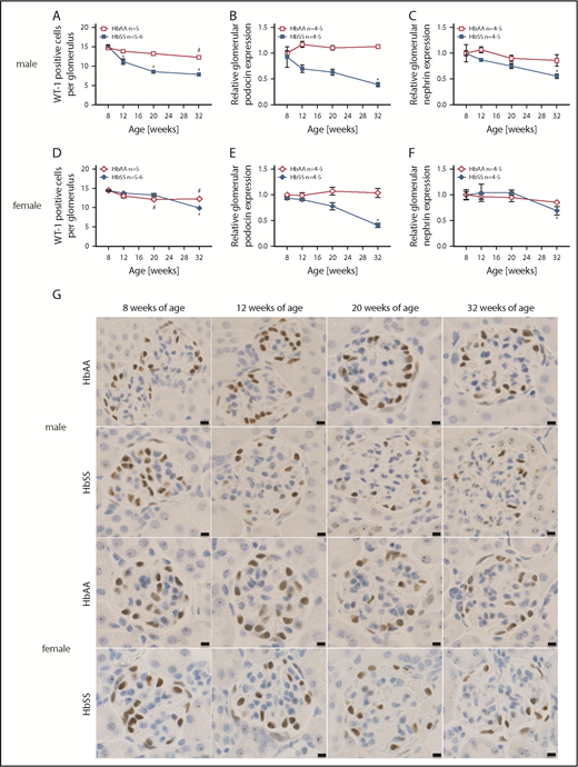 Figure 3. Data showing the time course of glomerular injury in male and female HbSS and HbAA mice. (A) Quantification of WT-1+–stained glomerular sections from male HbAA and HbSS mice represented as number of WT-1+–stained cells per glomerulus. (B) Relative glomerular podocin expression in glomeruli isolated from male HbAA and HbSS mice. (C) Relative glomerular nephrin expression in glomeruli isolated from male HbAA And HbSS mice. (D) Quantification of WT-1+–stained glomerular sections from female HbAA and HbSS mice represented as number of WT-1+–stained cells per glomerulus. (E) Relative glomerular podocin expression in glomeruli isolated from female HbAA and HbSS mice. (F) Relative glomerular nephrin expression in glomeruli isolated from female HbAA and HbSS mice. (G) Representative WT-1+–stained sections of glomeruli from male and female HbAA and HbSS mice. Original magnification ×40; scale bars = 50 μm. Data are mean ± SEM; *P < .05 vs 8-week HbSS; #P < .05 vs 8-week HbAA. Analysis with 2-way ANOVA with Tukey post hoc analysis. (A) Interaction, genotype, and age, P < .0001. (B) Interaction and age, P < .0001; genotype, P = .4236. (C) Interaction, P = .0028; genotype, P < .0001; age, P = .0739. (D) Interaction and genotype, P < .0001; age, P = .0004. (E) Interaction, P = .2687; genotype, P = .0039; age, P = .0017. (F) Interaction, P = .5020; genotype, P = 9953; age, P = .0411.
