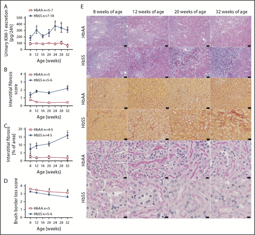 Figure 4. Measures of renal tubular injury progression in male HbSS mice compared with genetic controls (HbAA). (A) Trajectory of kidney injury marker 1 (KIM-1) in male HbAA and HbSS mice. (B) Quantification of interstitial fibrosis index score in male HbAA and HbSS mice. (C) Quantification of interstitial fibrosis index score in male HbAA and HbSS mice. (D) Quantification of brush border loss index score in male HbAA and HbSS mice. (E) Representative Masson trichrome–, Picro Sirius Red–, and periodic-acid Schiff–hematoxylin-stained sections of renal cortex and medulla from male HbAA and HbSS mice. Original magnification ×10 (scale bars = 100 μm) for Masson trichrome staining and ×40 (scale bars = 50 μm) for Picro Sirius Red and periodic-acid Schiff–hematoxylin stainings. Data are mean ± SEM; *P < .05 vs 8-week HbSS mice. #P < .05 vs 8-week HbAA mice. Analysis by 1-way ANOVA with repeated measurements with Tukey post hoc analysis. (A) Genotype, P < .0001; age, P = .0437, or 2-way ANOVA with Tukey post hoc test. (B) Interaction, P = .0140; genotype, P < .0001; age, P = .2854. (C) Interaction, P = .1065; genotype, P < .0001; age, P = .2016. (D) Interaction, P = .3515; genotype and age, P < .0001.