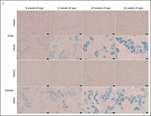Time course in additional measures of renal tubular injury in male and female HbSS mice compared with genetic controls (HbAA). (A) Relative NGAL expression in renal cortex of male HbAA and HbSS mice. (B) Relative NGAL expression in renal cortex of female HbAA and HbSS mice. (C) Relative megalin expression in renal cortex of male HbAA and HbSS mice. (D) Relative megalin expression in renal cortex of female HbAA and HbSS mice. (E) Quantification of iron deposition in the whole kidney scans (represented as megapixels per micrometer) in male HbAA and HbSS mice. Original magnification ×40; scale bar = 50 μm. (F) Quantification of iron deposition in the whole kidney scans (represented as megapixels per micrometer) in male HbAA and HbSS mice. (G) Relative caspase-3 expression in renal cortex of male HbAA and HbSS mice. (H) Relative caspase-3 expression in renal cortex of female HbAA and HbSS mice. (I) Relative HIF-1α expression in renal cortex of male and females HbSS mice. (J) Representative Prussian blue–stained sections of renal cortex from male and female HbAA and HbSS mice. Original magnification ×10; scale bar = 100 μm. Data are mean plus or minus SEM; *P < .05 vs 8-week HbSS mice; **P < .05 vs age-matched males HbSS. Analysis by 2-way ANOVA with the Tukey post hoc test. (A) Interaction, P = .0099; genotype, P < .0001; age, P = .0097. (B) Interaction, P = .0031; genotype, P < .0001; age, P = .0234. (C) Interaction, P = .0176; genotype, P < .0001; age, P = .0184. (D) Interaction, P = .2074; genotype, P = .0119; age, P = .1529. (E) Interaction, P = .0002; genotype, P < .0001; age, P = .0002. (F) Interaction, P = .4335; genotype, P < .0001; age, P = .1189. (G) Interaction, P = .3509; genotype, P < .0001; age, P = .3981. (H) Interaction, P = .0007; genotype, P < .0001; age, P = .7121, or unpaired Student t test (I).