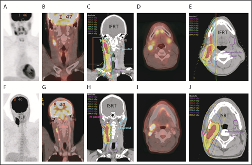 Figure 1. Treatment of stage IA NLPHL of the right neck with IFRT vs ISRT. Diagnostic PET-CT scout (A), coronal (B), and axial (D) images of a patient with fluorodeoxyglucose-avid stage IA NLPHL of the right neck treated with IFRT. Coronal (C) and axial (E) CT images from the 3-dimensional radiation treatment plan illustrate the gross disease (contoured in red) and the extended clinical treatment volume (contoured in yellow). Diagnostic PET-CT scout (F), coronal (G), and axial (I) images of a second patient with stage IA NLPHL of the right neck treated with ISRT. Coronal (H) and axial (J) images from the RT plan illustrate the gross tumor volume (contoured in red) and the more limited clinical tumor volume (contoured in yellow).