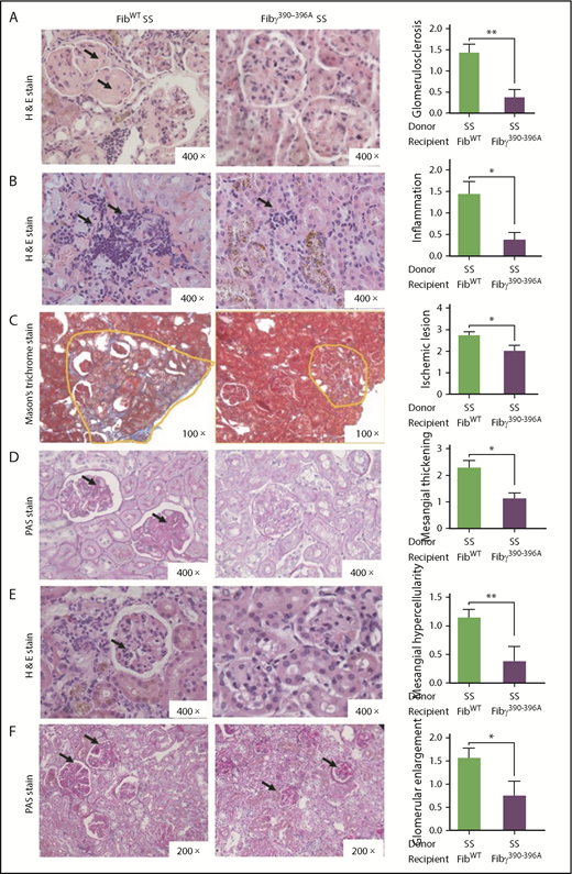 Figure 4. Fibγ390-396A protects SCA-associated glomerular pathology. Fully chimeric sickle mice were followed for 1 year posttransplant; kidney samples were fixed in formalin after the mice were euthanized, and stained with H&E and PAS reagent. Representative kidney sections of FibWT SS mice (left panel), Fibγ390-396A SS mice (middle panel) and semiquantitative scoring of histologic features (right panel) showing glomerulosclerosis (A), inflammatory cell infiltration (B), ischemic lesions (C), glomerular mesangial thickening (D), glomerular mesangial hypercellularity (E), and glomerular enlargement (F) are reduced in Fibγ390-396A SS mice compared with the FibWT SS mice. Histopathology scores ranged from 0 to 5, where 0 represents normal kidney morphology; 1, changes in <20% of glomerular area; 2, 21% to 40% of the glomerular area; 3, 41% to 60% of the glomerular area; 4, 61% to 80% of glomerular area; and 5, severe changes in almost all glomeruli. Similar number of fully chimeric male and female mice were used in the experimental groups. The bars in the graph indicate the mean ± SEM. Statistical analyses of the histologic scores were done by Mann-Whitney U test; statistical significance between FibWT SS (n = 7) and Fibγ390-396A SS (n = 8) mice is indicated as **P ≤ .01, *P ≤ .05.