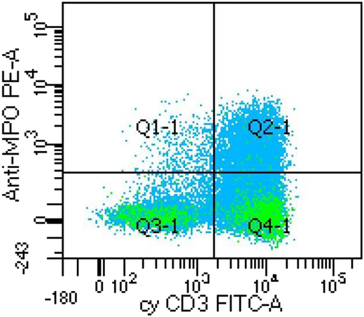 A case of mixed phenotype acute leukemia (T/myeloid) showing dual positive for MPO and cyCD3. Unit of measure is number of dots. Anti-MPO PE-A, myeloperoxidase antibody conjugated with phycoerythrin; cyCD 3 FITC-A, cytoplasmic CD3 antibody conjugated with fluorescein isothiocyanate; Q1-1, MPO positive; Q2-1, both MPO and cyCD3 positive; Q3-1, both MPO and cyCD3 negative; Q4-1, cyCD3 positive.
