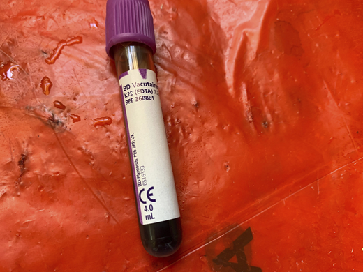 Poor labeling practice. An anticoagulant-coated specimen tube with no patient details on its label was sent out with a request for blood count analysis.