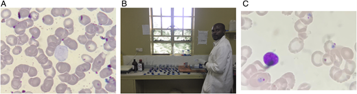 Stained sample slides and staining procedures. (A) The staining process failed because of poor uptake of basophilic dye by white blood cells. (B) Laboratory staff assessing a variety of staining protocols. (C) Successful staining of a lymphocyte (the pediatric patient was unexpectedly found to have falciparum malaria).
