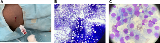 BM aspiration procedure and aspirates. (A) BM aspiration using a spinal needle. BM smear slides showing (B) BM aspirate from a spinal needle and (C) sixth successful BM aspirate with cells indicative of suspected metastatic disease.