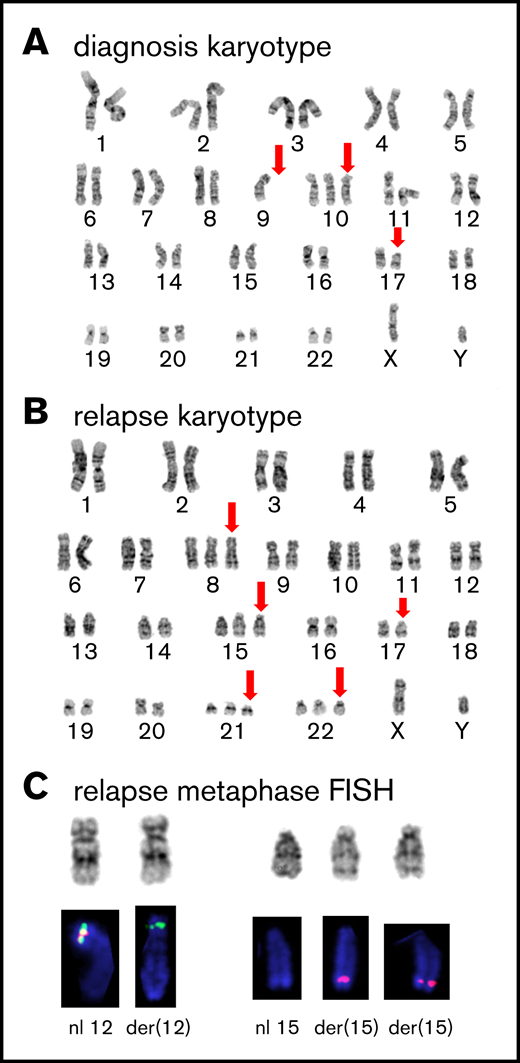 Cytogenetic analysis. (A) GTG-banded representative karyotype at diagnosis showing a 46,XY,-9,+10,del(17)(p11.2) karyotype; abnormal or absent chromosome marked by red arrows. (B) Representative karyotype during relapse showing a 50,XY, +8,+15,del(17)(p11.2), +21,+22 karyotype; abnormal chromosomes marked by red arrows. (C) Partial FISH analysis on chromosomes 12 and 15 demonstrate the cryptic rearrangement t(12;15)(p13q26) and the additional der(15)t(12;15): the 3′ETV6(Cen) signal (green) remains on der(12)t(12;15), and 2 copies of the 5′ETV6 (Tel) signal (red) translocated on 2 copies of der(15)t(12;15).