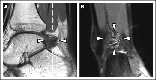 MRI of a right ankle with synovial hypertrophy and hemosiderin deposits. Synovial hypertrophy and hemosiderin deposits (arrowheads) on a sagittal T1-weighted MRI (A) and the coronal proton density–weighted MRI with fat suppression (B). The dashed white line in panel A represents the imaging plane of panel B.