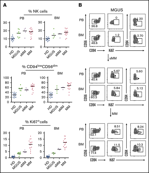 NK cell features during the early phases of disease: from MGUS to MM. (A) Comparative analysis of frequency of total NK cells (top), frequency of CD94lowCD56dim NK cells (middle), and frequency of Ki67+ NK cells (bottom) in PB and BM of MGUS, sMM, and MM patients compared with HDs. (B) NK cell analysis in a representative patient evolving from MGUS to sMM and eventually to MM. Dot plots depict frequency of CD94lowCD56dim NK cells and Ki67 analyzed on NK cells from both PB and BM of the patient along disease progression.