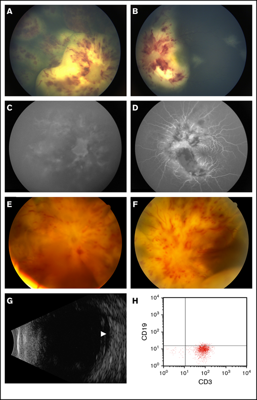 Ocular findings at presentation and following treatment with CAR T-cell therapy. (A-D) Color fundus photography and fluorescein angiography at presentation. (A) The right eye features optic disc infiltration and leukemic retinal infiltrates and hemorrhages. (B) The left eye has leukemic disc infiltration, as well as scattered retinal infiltrates sparing the macula. (C) Fluorescein angiography of the right eye shows minimal perfusion of the choroidal and retinal circulations. (D) The left eye has relatively maintained choroidal and retinal vascular filling, with blockage in areas of leukemic infiltration and hemorrhage. (E-F) Color fundus photography following CAR T-cell therapy. The right (E) and left (F) eyes demonstrate worsened retinal whitening, hemorrhages, and optic disc edema with total exudative retinal detachments. (G) Ocular ultrasound of the right eye demonstrates subretinal fluid (arrowhead) without evidence of choroidal involvement. (H) Flow cytometry of the right aqueous humor demonstrates a predominance of CD3+CD19− cells.