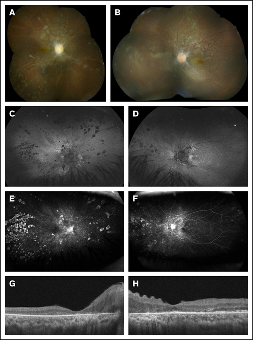 Multimodal retinal imaging at 18 months post–CAR T-cell therapy. (A) The right eye has severe optic disc pallor, diffuse retinal atrophic changes, and sclerotic vessels. (B) The left eye has moderate-severe optic disc pallor and retinal atrophic changes. (C-D) The retina is entirely attached in both eyes. Fundus autofluorescence shows bilateral stippled and nummular areas of hyper- and hypoautofluorescence representing areas of photoreceptor and retinal pigment epithelium damage. Late-phase fluorescein angiography reveals peripheral window defects in the right eye (E) that are more common than in the left eye (F) with staining of the disc bilaterally. (G) Spectral-domain optical coherence tomography shows diffuse photoreceptor loss in the right macula. (H) The left macula has relative preservation of the photoreceptor bands and corrugation of the inner retina.