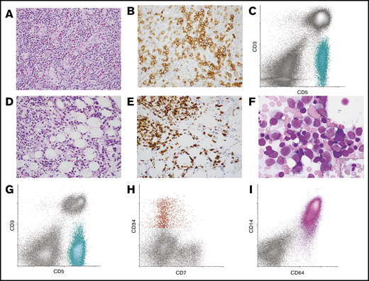 Lymph node and BM morphology with corresponding FC histograms from patient 10 with AITL and AML. (A-B) Lymph node was effaced by an infiltrate of small to intermediate-sized lymphoid cells with moderate amounts of pale cytoplasm in a background of mixed inflammatory cells and vascular proliferation (A, hematoxylin and eosin stain, original magnification ×400). (B) The neoplastic T cells expressed PD-1 by immunohistochemistry (original magnification ×400). (C) FC analysis of the lymph node demonstrated an abnormal T-cell population that was surface CD3(−) and CD5(+) (aqua population). These cells were also positive for CD4, CD2, and PD-1 (not shown). The findings were consistent with AITL. (D-F) Subsequent BM biopsy demonstrated aggregates of atypical lymphoid cells as well as increased blasts and promonocytes. (D) Hematoxylin and eosin–stained core biopsy, original magnification ×400. (E) CD3 immunohistochemistry performed on the core biopsy specimen highlighted the neoplastic T cells (original magnification ×400). (F) Wright-Giemsa–stained aspirate smear demonstrated frequent blasts/promonocytes as well as dysgranulopoiesis (inset) and dyserythropoiesis (original magnification ×1000). (G-I) FC analysis of the BM detected a surface CD3(−), CD5(+) abnormal T-cell population similar to that seen in the lymph node (aqua population) (G) as well as a small abnormal CD34(+) myeloid blast population with dim CD7 expression (red population) (H) and an expanded CD64(+) monoblast population (pink population) (I). The findings were consistent with BM involvement by both AITL and AML with monocytic differentiation.