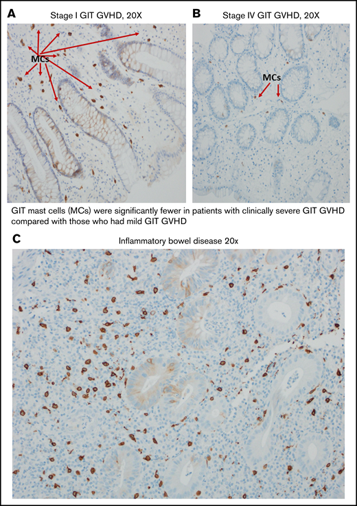 Mast cells in patients with clinical GIT GVHD and IBD. Stage 1 (A) and stage 4 (B) GIT GVHD. (C) Increased mast cells in a patient with IBD.