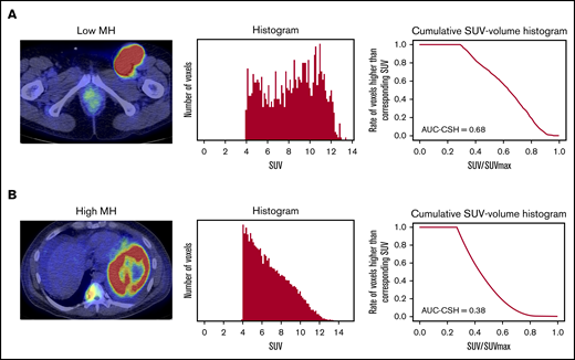 Evaluation of AUC-CSH on18FDG-PET/CT. Axial PET/CT imaging (left panels) and the corresponding histogram drawn by number of the voxels with corresponding SUV (middle panels) and cumulative SUV-volume histogram (right panels) in a patient with low MH (A) and a patient with high MH (B).
