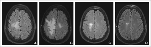 FLAIR MRI images. Axial FLAIR MRI images were obtained before initiation of N-803 (A), after 2 cycles (B) and 8 cycles (C) of N-803, and 759 days after initiation of N-803 (D), demonstrating improvement in the posterior right frontal subcortical white matter lesion.
