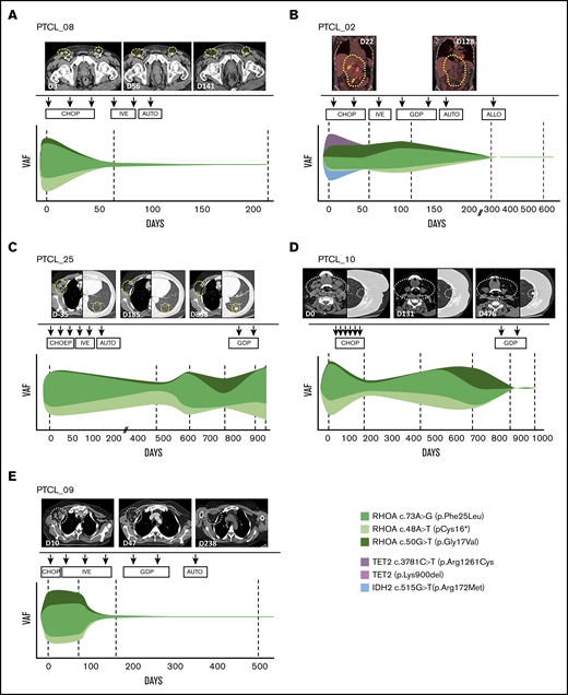 RHOA mutations can be followed over time and correlate with radiological measures of response. Clonal tides representing mutation dynamics for RHOA and, where possible, TET2 and IDH2, during treatment of 5 PTCL cases. VAFs are plotted as indicated by the color key to the lower right. The dotted vertical lines indicate the points at which samples were taken. (A) PTCL_08 was treated with cyclophosphamide, Adriamycin, vincristine, and prednisolone (CHOP) chemotherapy and achieved a radiological complete response. Subsequent consolidation was with ifosfamide, epirubicin, and etoposide (IVE) followed by a lomustine, etoposide, cytarabine, melphalan (HDT/LEAM)–conditioned autologous stem cell transplant. Data were obtained from Ion Torrent sequencing. (B) PTCL_02 had disease refractory to 2 lines of chemotherapy (CHOP and IVE) before achieving a PET-negative response with gemcitabine, dexamethasone, and cisplatin (GDP). Treatment was then consolidated with an autologous followed by an allogeneic stem cell transplant. The data for the 4 timepoints indicated by black dotted lines are taken from Ion Torrent sequencing data and those indicated by red dotted lines from ddPCR. (C) PTCL_25 was treated with CHOP with etoposide (CHOEP) chemotherapy but did not respond and then received IVE followed by HDT/LEAM autologous stem cell transplant. PTCL recurred 2 years later, and reinduction chemotherapy with GDP achieved a transient partial response before further progression occurred and the patient died. Data were obtained from Ion Torrent sequencing. (D) PTCL_10 was treated with CHOP chemotherapy and achieved a partial remission on CT scan. The remission lasted ∼18 months, but she then represented with a rising peripheral blood lymphocyte count, pruritus, and skin lesions. CT scan (day 476) showed lung nodules. Lymph node biopsy confirmed relapsed lymphoma, and she was retreated with GDP. In this case, loss of mutant RHOA after GDP was associated with disease progression. Data were obtained from Ion Torrent sequencing. (E) PTCL_09 was treated with CHOP chemotherapy but progressed clinically and was treated with IVE, achieving a partial response. The response was consolidated with GDP and autologous stem cell transplantation. Data were obtained from ddPCR.