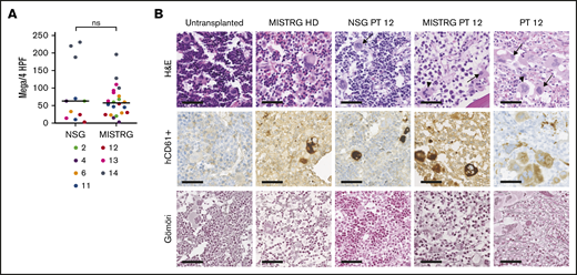 Immunohistochemical analysis of MF engrafted NSG and MISTRG mice BM. (A) Number of human megakaryocytes (Mega, CD61+) per 4 high power fields (HPF, equaling 1 mm2) in NSG and MISTRG mice for patient (PT) samples with ≥10% hCD45+ (grand median, unpaired Student t test). (B) Representative IHC analysis for hCD61 and Gömöri (stains reticulin fibers) of the BM of an untransplanted MISTRG mouse, a MISTRG mouse transplanted with a healthy donor sample (HD), a NSG and a MISTRG mouse transplanted with sample from a post–essential thrombocythemia patient (PT 12), and the BM biopsy from the same patient (scale bars, 50 µm; original magnification ×400). Arrows point to atypical human MF megakaryocytes. Arrowheads point to atypical human ET megakaryocytes. ns, not significant.