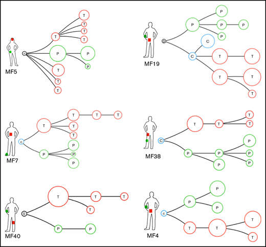 Phylogenetic relationship between different lesions in the same patient: topologic heterogeneity in MF. Pairs of LSP and tumor (TMR) biopsies were collected from 6 patients and analyzed as in Figure 4. Red branches represent TMR (T), green branches symbolize evolution of the LSP (P). Blue circles represent common clones shared by TMRs and LSPs (C). Black circle represents a phylogenetic tree without an identifiable ancestor clone.