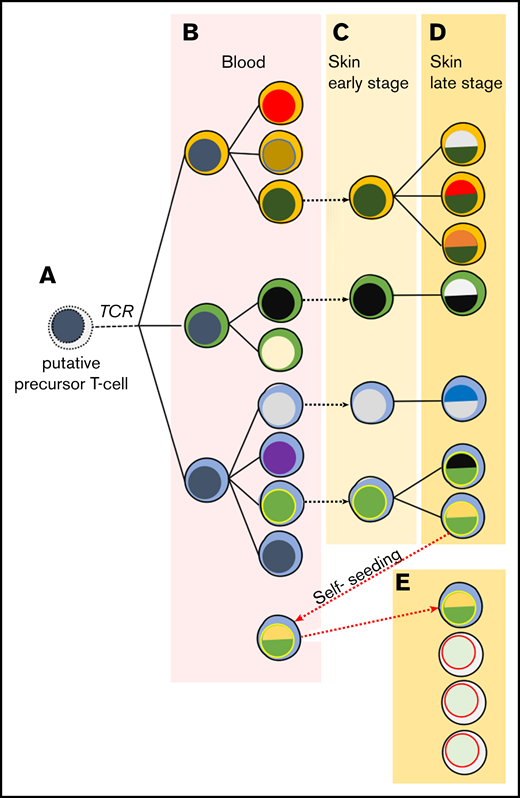 Proposed model of the evolution of MF. Skin lesions of MF are formed by seeding with the circulating malignant T-cell clones, which undergo further mutational evolution. (A) It is likely malignant clones originate from an immature T cell transformed before TCRB rearrangement and therefore show clonotypic heterogeneity (highlighted by different colors of the cytoplasm). (B) These circulating neoplastic T cells undergo expansion and accumulate mutations, leading to emergence of genetically different malignant subclones (different colors of the nucleus). Some of the circulating malignant cells seed into the skin (stippled gray arrows) (C), where they proliferate, accumulate additional mutations, and develop additional subclones as the disease progresses (D). (E) Some subclones may reenter the circulation and seed other skin lesions (red stippled arrow), further increasing the heterogeneity of the lesions and causing disease progression. Solid lines symbolize the phylogenetic relationship between generations of malignant cells that follow the pattern of divergent, neutral evolution. Data from this study and our previous work.7,29,50,51