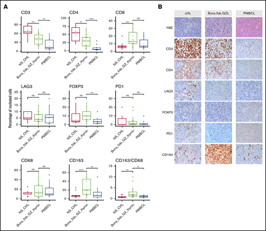 Microenvironment composition as assessed by IHC staining. (A) Box plots represent the percentage of nucleated cells that are positive for each given marker (P values calculated with Student t tests). T-cell subsets were analyzed by using CD3, CD4, CD8, FOXP3, PD1, and LAG-3. Macrophage subsets were identified by using CD68 and CD163. (B) Representative images of cHL, thymic bona fide GZL (ie, groups 1 and 2 with thymic involvement), and PMBCL tissue stains. Original magnification at 400× for all images. **P ≤ 0.01; ***P ≤ .001; ****P ≤ .0001. H&E, hematoxylin and eosin; ns, not significant (P > .05).