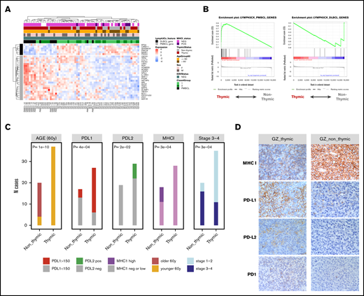 Comparison of thymic and non-thymic bona fide GZL cases. (A) Unsupervised clustering of the bona fide GZL (groups 1-2) samples using the 30 genes defined in the Lymph3Cx signature. The 6 DLBCL genes form a distinct cluster, suggesting that the sample clustering may reflect tumor cell biology. The majority of non-thymic GZL cases form a cluster on the right with high DLBCL gene expression. Conversely, the thymic cases show high expression of the PMBCL genes. (B) Enrichment of the 6 DLBCL and 24 PMBCL Lymph3Cx genes was assessed in the GZL cases using preranked GSEA, with genes ordered by the DE score between thymic and non-thymic GZL. Thymic cases are enriched in the PMBCL signature (adjusted P < .0001), whereas non-thymic cases were enriched in the DLBCL signature (adjusted P = .05). (C) Main clinical and IHC distinctions between thymic and non-thymic GZL. The H score for PDL1 was dichotomized as high (≥150) or low (<150). The H score for PDL2 was dichotomized as positive (>0) or negative (= 0). The MHC-I score was dichotomized as negative, low (cytoplasmic or no expression, or membranous expression in <90% of the tumor cells), or high (membranous expression in >90% of the tumor cells). (D) IHC of representative bona fide GZL thymic and non-thymic tumors for PD1, PD-L1, PD-L2, and MHC-I staining.  Original magnification at 400× for all images.