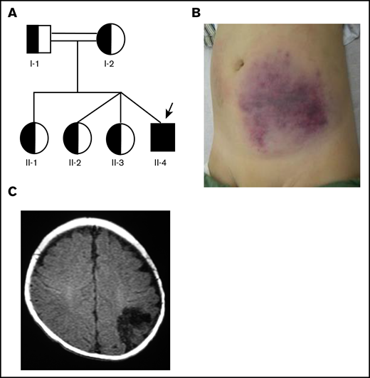 The patient’s signs and family pedigree. (A) The patient’s family pedigree. The patient is a fraternal triplet and his parents were second cousins. He is homozygous for G1289A mutation of the TM gene. Other family members are heterozygous for this mutation. (B) Subcutaneous bleeding that repeatedly appeared almost every week. (C) Brain computed tomography scan showing an old cerebral infarction, possibly due to embolism with a blood clot that was formed in the venous system and shifted to an arterial current through the foramen ovale during the fetal period.