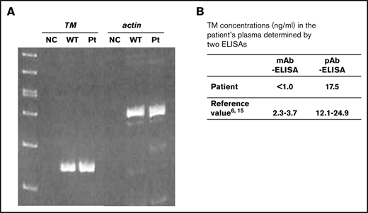 The TM G412D gene expression (RT-PCR products) and protein production in the patient. (A) The expression of TM G412D mRNA in the PBMCs of the patient (Pt) was detected by RT-PCR and was comparable with that in PBMCs of a healthy control (WT). NC, negative control. (B) The TM G412D protein concentration in the patient’s plasma was found to be 17.5 ng/ml using a pAb-ELISA, but was not detected by mAB-ELISA, recognizing the thrombin-binding site (MFTM-4).