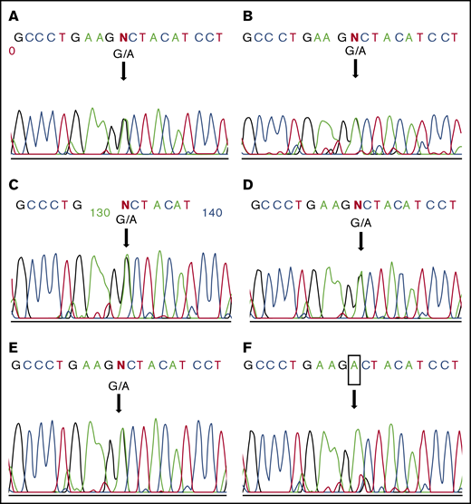 The TM gene sequences of patient’s family. Other family members (A, father; B, mother; C, elder sister; D-E, triplet sisters) were heterozygous for the G1289A mutation of the TM gene, while the patient (F) was homozygous.
