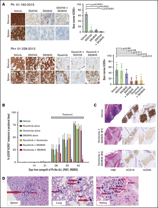 Interrogating prosurvival protein dependency in vivo in Ph+, Ph-like, and Ph− B-ALL PDX using BH3-mimetic drugs alone and in combination. (A) Irradiated NSG mice were transplanted with 1 × 106 primary B-ALL cells (Ph− 01-160-2015 or Ph+ 01-228-2012). Engraftment was confirmed at 6 weeks by detection of hCD45 in peripheral blood. Cohorts of 4 mice per group were then treated with (i) vehicle, (ii) S55746 (BCL-2 inhibitor), (iii) S63845 (MCL-1 inhibitor) or (iv) S55746 combined with S63845, and (v) dasatinib or (vi) dasatinib + S55746 (for 01-228-2012). Mice were euthanized on day 8, and immunohistological analysis for hCD45+ was performed on sternal bone marrow and spleen for infiltration by B-ALL cells captured at 100× magnification using the Aperio ScanScope. Representative cases from each cohort are shown. Flow cytometric analysis of flushed femurs showing the percentage of human CD45+ cells from B-ALL 01-160-2015 or 01-228-2012 after indicated treatments (mean ± 1 standard deviation and individual mouse values shown). B-ALL 01-160-2015 vehicle (n = 4), S63845 (n = 4), S55746 (n = 5), S55746+S63845 (n = 5). B-ALL 01-228-2012 vehicle (n = 4), S63845 (n = 3), S55746 (n = 3), S55746+S63845 (n = 4), dasatinib (n = 3), dasatinib + S63845 (n = 4). (B-C) NSG mice were transplanted with 1 × 106 Ph-like ALL cells (P2RY8-CRLF2 + JAK2 IR682RG). Leukemia engraftment and progression were assessed in groups of 6 female mice per treatment arm as shown with dosage regimen described in the “Methods.” (B) Treatment began when the mice engrafted 1% to 5% and human CD45+ cells and CD19+ proportion in peripheral blood (% hCD45+CD19+) were monitored weekly. *P = 0.0024 for Venetoclax + S63845 compared to vehicle by Mantel-Cox test. (C) Representative recipient sternal sections stained for hCD19 and hCD45 after treatment with vehicle (top) or Venetoclax + S63845 (middle and bottom, 2 independent recipients). Images taken at 20× magnification using the Panoramic Scan II by 3D Histech. (D) When venetoclax and S63845 were combined, fatal murine ATLS was observed with multiorgan involvement consisting of widely disseminated microemboli composed of nuclear and cytoplasmic debris derived from lysed leukemia cells, seen as deeply basophilic homogenous material as indicated by the arrows in spleen, lung, and kidney glomerulus.17,18 Images captured using the Olympus Model BX41 and Olympus U-CMAD 3 camera at 200× magnification (spleen and lung) and 400× magnification (kidney). H&E, hematoxylin and eosin.