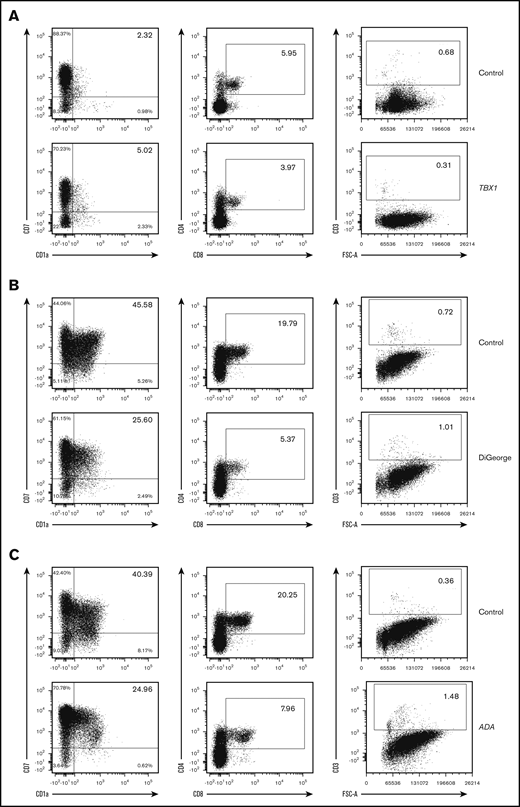 Normal in vitro T-cell differentiation of PB-CD34+cells from SCID patients with thymic defects and ADA deficiency. (A) A total of 5000 CD34+ cells from PB of a TBX1 SCID patient and control (cord blood) were differentiated in 3D culture for 5 weeks. (B) A total of 1900 CD34+ cells from PB of a DiGeorge syndrome SCID patient and control (PB of a healthy adult donor) were differentiated in 3D culture for 5 weeks. (C) A total of 2000 CD34+ cells from PB of an ADA SCID patient and control (PB of a healthy adult donor) were differentiated in 3D culture for 3 weeks. Displayed events are gated from single cells, negative for 7-AAD and positive for human CD45. Percentages among CD45+7-AAD−CD34−CD19− cells (left column) and CD45+7-AAD− cells (2 right columns) are indicated in inlets.