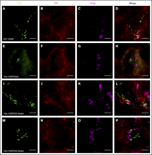 Widefield fluorescence microscopy of recombinant heterozygous in-frame deletions. HEK293 cells were transfected with WT rVWF only (A-D) and WT rVWF with either rVWF3del (E-H), rVWF32-34del (I-L), or rVWF33-34del (M-P) in a 1:1 ratio. Cells were fixed and stained for VWF (green), ER (red), and Golgi (magenta). Scale bars, 5 μm.