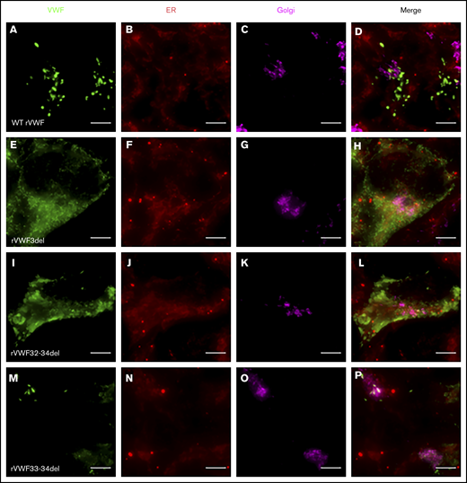 Widefield fluorescence microscopy of recombinant homozygous in-frame deletions. HEK293 cells were transfected with WT rVWF only (A-D) and either rVWF3del (E-H), rVWF32-34del (I-L), or rVWF33-34del (M-P). Cells were fixed and stained for VWF (green), ER (red), and Golgi (magenta). Scale bars, 5 μm.