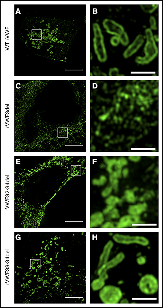 SIM imaging of pseudo-WPB formation in recombinant homozygous in-frame deletions. Expression of WT rVWF produced numerous pseudo-WPB (A), which, on close inspection, had bright outer membrane staining (B). (C) rVWF3del expression produced a diffuse, speckled network-like staining pattern. (D) No large VWF-positive structures were visible. (E) rVWF32-34del expression also produced a more diffuse staining pattern, although with apparent VWF-positive structures. (F) However, the VWF-positive structures displayed uniform staining intensity and nonuniform structure, possibly representing aggregates of VWF oligomers. rVWF33-34del expression was able to form pseudo-WPB like structures (G); however, numerous rounded structures were also visible (H). Scale bars, 5 μm (A,C,E,G) and 1 μm (B,D,F,H). Panels B, D, F, and H are higher magnifications of the region of interest in panels A, C, E, and G (denoted by the white box).
