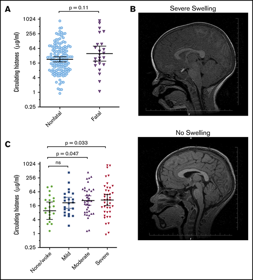 Extracellular histones are associated with the degree of brain swelling demonstrated on MRI scan. (A) Serum histone levels at admission in children who went on to die (Fatal; n = 24) and in those who survived (Nonfatal; n = 146). Differences between these groups were compared using a Student t test on log-transformed data. (B) Typical example of an MRI from a Malawian child with Ret+CM with a severely swollen brain (top) compared with an MRI from a Malawian child with Ret+CM with no swelling (bottom). (C) Circulating histones in children presenting with Ret+CM at different levels of brain swelling: those with no evidence of brain swelling or who woke up on the day of admission before they had a scan (n = 22) compared with mild (n = 22), moderate (n = 37), or severe brain swelling (n = 40). Black lines and error bars indicate geometric mean and 95% CI. Differences between the groups were compared by an ANOVA on log-transformed data with the Dunnett’s test to compare individual differences between no swelling and other swelling groups.