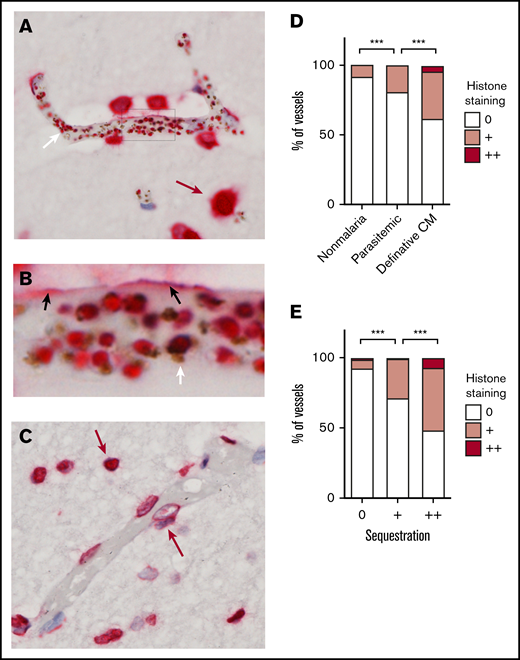 Histones accumulate at the endothelial surface in the cerebral microvasculature and are associated with sequestration. (A,B) Fatal definitive CM cases showing histone staining in close proximity with endothelial cell luminal surface and marks host cell nuclei (red arrow) as well parasite nuclei in IE (white arrow). (B) Enlarged image of panel A to show luminal histone staining (black arrows) as well as IE with histone staining. (C) Fatal parasitemic non-CM comatose case (Parasitemic) with no histone endothelial membrane binding; histone staining can be seen in mammalian cell nuclei (red arrows). (D) Luminal histone staining is markedly increased in definitive CM (n = 17) compared with parasitemic non-CM cases (Parasitemic, n = 6) or fatal nonmalarial comatose illness CM cases (nonmalaria; n = 5). (E) In definitive CM cases (n = 17); there is a strong association between the degree of sequestration and the presence and strength of histone membrane staining (determined by ordinal logistic regression). Red staining is to antihistone H3 using Vector Red. Images were acquired at ×600 using an oil immersion lens.