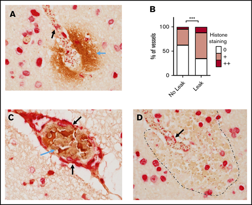 Luminal bound histones colocalize with areas of BBB breakdown and coagulopathy. (A) Histone endothelial membrane staining (black arrows) colocalizing with fibrinogen extravasation (blue arrow), which is indicative of BBB breakdown. (B) Strong association between the extent of histone endothelial membrane staining and the presence of fibrinogen extravasation, determined by ordinal logistic regression. (C) Histone membrane staining (black arrows) colocalizing with thrombosis (blue arrow). (D) Histone membrane staining (black arrow) colocalizing with a ring hemorrhage (edge demarcated by dotted line). Red staining is to anti-H3 antibody using Vector Red and brown staining is to antifibrinogen antibody using 3,3′-diaminobenzidine. Images were acquired at ×600 using an oil immersion lens.