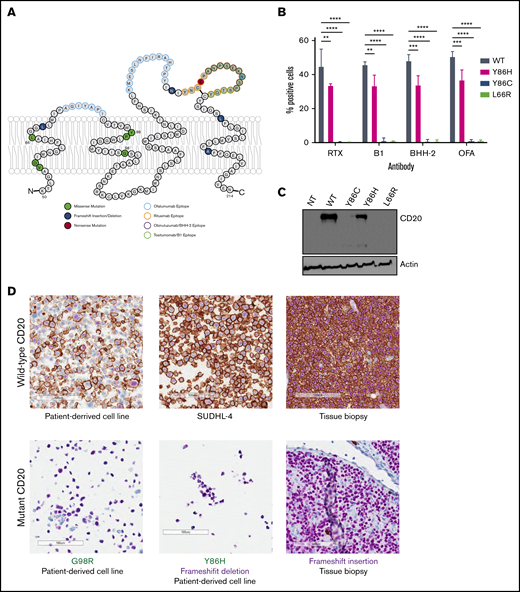 Distribution and functional impact of MS4A1 mutations in rrDLBCL. (A) Topology of MS4A1 transmembrane domains and extracellular loops, as annotated by Uniprot and elsewhere.47MS4A1 mutations observed in the rrDLBCL cohort have been labeled, along with the predicted binding epitope of 4 different CD20 mAbs. (B) Comparison of antibody binding between CHO-S cells transfected with plasmids expressing either WT CD20 or 1 of 3 mutants (Tyr86His, Tyr86Cys, and Leu66Arg) for 4 different CD20 antibodies: rituximab (RTX), tositumomab (B1), obinutuzumab (BHH-2), or ofatumumab (OFA). The percent of positively stained cells was compared between mutants within each antibody (adjusted P values from 2-way analysis of variance of 3 replicates: *P > .1, **P > .01, ***P > .001, ****P > .0001). See also supplemental Figure 5. (C) Representative western blot (of 2 independent experiments performed) showing CD20 expression of CHO-S cells transfected with WT or mutant CD20 (Y86H, Y86C, and L66R) and a nontransfected (NT) control. (D) Immunohistochemistry of CD20 in a cell line and tumor tissue biopsy harboring WT CD20 as well as 2 patient-derived cell lines harboring G98R (PT255), and Y86H along with a frameshift mutation, respectively. CD20 is stained red using the L26 CD20 antibody and B-cell nuclei were stained purple using a Pax5 antibody, visualized at ×20 original magnification.