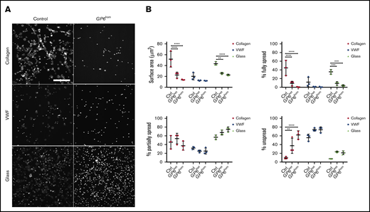 Platelet spreading on collagen, VWF, and glass. (A) Human platelets (2 × 107/mL) were spread on coated and uncoated (not blocked) coverslips as described in “Methods.” The images are representative of 3 control and 3 GP6hom patients. (B) The graphs illustrate quantification of surface area and the percentage of fully, partially spread, or nonspread platelets (control = 3, GP6het = 2, GP6hom = 3). Measurements are the mean of 48 882 platelets in a replicate (7 fields of view per replicate), and the figures are representative of part of a field of view. Significance was measured using 2-way ANOVA. **P < .01, ***P < .001; ****P < .0001. The surface area in the field of view is 213 × 213 μm. Scale bar, 50 μm.