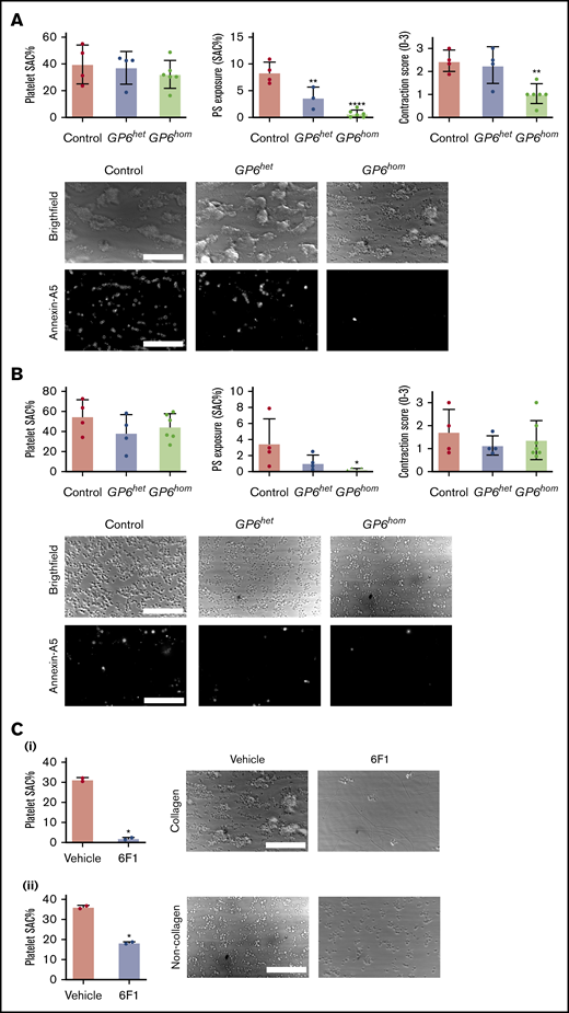 GPVI deficiency leads to abolished PS exposure under flow in the absence of coagulation. Whole blood from control, GP6hom, and GP6het subjects was recalcified in presence of PPACK and perfused over collagen (A) and noncollagen (B) (laminin, VWF, and rhodocytin) surfaces. Surface area coverage (SAC), PS exposure, and contraction score are presented as mean ± SD; control = 4, GP6het = 4, and GP6hom = 6. ****P < .0001, **P < .01, *P < .05. Representative bright-field and Alexa Fluor 647-Annexin A5 images are shown. Images were taken at the end point (8 min) after labeling was performed. (C) Whole blood from GP6hom patients treated with the monoclonal antibody 6F1 (10 μg/mL) was recalcified and perfused over collagen (i) and noncollagen (ii) surfaces. Quantification of surface area coverage is presented as mean ± SD. GP6hom= 2. Representative bright-field images are shown. Scale bars, 50 μm.