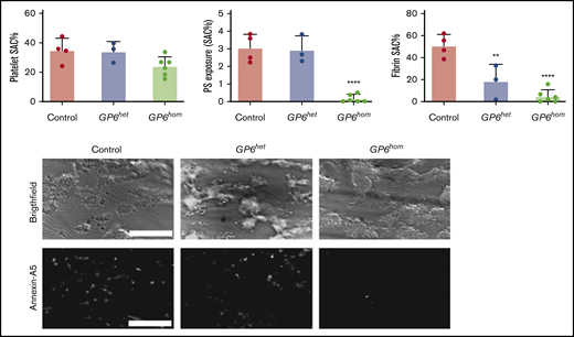 GPVI deficiency leads to abolished PS exposure under flow. Whole blood from control, GP6hom, and GP6het individuals was recalcified and perfused over a collagen surface cocoated with tissue factor. Quantification of surface area coverage (SAC), PS exposure, and fibrin surface area coverage is shown. Data are shown as mean ± SD; control = 4, GP6het = 3, and GP6hom = 6. ****P < .0001, **P < .01. Representative bright-field and Alexa Fluor 647-Annexin A5 images taken after 6 minutes of blood perfusion are shown from a control and a GP6hom subject on a collagen surface. Scale bars, 50 μm.