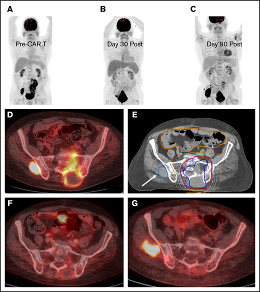 BT with a focal RT field in a CAR T-cell patient. Scout (A) and axial (D) images of a PET-CT scan in a male patient with primary refractory DLBCL who presented with cauda equina syndrome and a sacral mass. Emergent RT was administered with a 3-dimensional conformal RT plan that was transitioned to a volumetric-modulated arc therapy plan to a total dose of ∼43 Gy administered in 2.5-Gy fractions; the PET avid left gluteal mass (white arrow) was excluded from the RT field in an effort to limit bone marrow dose (E). The initial response assessment at day 30 revealed CR to therapy with a score of 2 on a 5-point scale (B,F). The 3-month post–axi-cel PET-CT scan revealed recurrent disease in the left gluteal region that was positive before axi-cel therapy but excluded from the RT field (C,G).