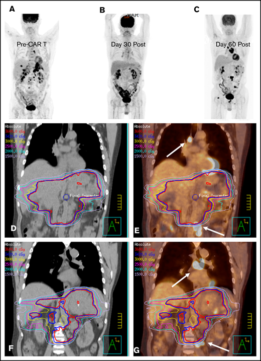 Bridging with a limited RT field in a CAR T-cell patient. (A) PET-CT scout image before CAR T-cell therapy in a male patient with primary refractory DLBCL. He presented 1 month after the illustrated PET-CT scan with severe abdominal pain, prompting CT imaging that revealed increased infiltrative soft tissue masses in the abdomen and pelvis (not shown). (D) Emergent RT was initiated with an intensity-modulated RT (IMRT) plan to the sites of symptomatic disease to an intended dose of 36 Gy; however, only 10.8 Gy was administered. (E) The IMRT plan fused to the sagittal pre–CAR T-cell PET-CT scan illustrates the sites of mediastinal and pelvic disease (arrows) that were excluded from the RT field. (B) The 30-day post–axi-cel PET-CT scan revealed PR to therapy, with a score of 4 on a 5-point scale. The 90-day post–CAR T-cell PET-CT scan (C) revealed new sites of disease progression outside of the RT field, as illustrated by the day-90 CT (F) and PET-CT (G) scans fused to the pre–CAR T-cell RT plan, with the arrows indicating the sites of disease progression outside of the RT field that were present before CAR T-cell therapy.