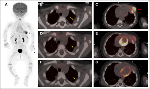 PET/CT scan of the chest at 3 time points. (A) Whole body anterior projection image from FDG PET/CT scan at diagnosis. Red arrow points to the FDG-avid left-sided chest wall mass. Sites of soft tissue uptake in both thighs represent injection sites from recent immunizations. Transverse fusion PET/CT sections through the thorax at baseline (B-C), following upfront standard therapy with vinblastine and steroids (D-E), and after therapy with dasatinib (F-G). At baseline, the mass extends into the subcutaneous fat of the left chest wall anteriorly and abuts the pericardium (C). The response to standard therapy was suboptimal with only mild reduction in size and FDG uptake (D-E). (G) Marked reduction in size as well as FDG avidity in response to dasatinib therapy. Yellow arrows point to sites of pleural thickening that were not FDG avid (1.4 × 1.8 cm). Note that the appearance of the pleural thickening did not change after standard therapy, but nearly resolved following dasatinib. Red arrows point at the large left-chest-wall mass centered at the left anterior fourth and fifth ribs and causing rib destruction.