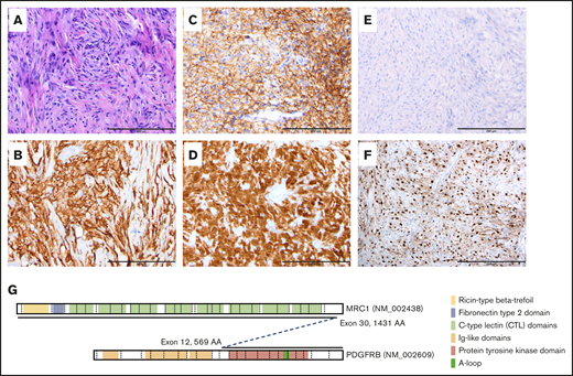 Histologic and immunohistochemical studies and schematic representation of somatic translocation. (A) Hematoxylin-and-eosin–stained section, original magnification ×20, showing diffuse sheets of histiocytoid cells set in a fibroinflammatory background. Immunohistochemical staining shows diffuse positivity for CD163 (B), CD33 (C), and factor XIIIa (D). No staining is noted for BRAF VE1 (E) and cyclin D1 (F) stains diffusely positive. (A-F) Scale bars, 200 μm. (G) Schematic representation of the MRC1-PDGFRB translocation.