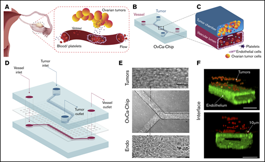 Organ-on-a-chip model of ovarian cancer vessel-platelet cross talk. (A) A human cancerous ovary with an injured blood vessel adjacent to tumors, with transmigrating blood cells. This interface is modeled with the OvCa-Chip. (B-C) Cross section of an OvCa-Chip. Two fluidic chambers (red, vessel; blue, cancer cells) in an adjacent superimposed position. (D) Computer-aided design showing the components of OvCa-Chip assembly in detail. The device was fabricated with PDMS soft lithography, with overlaid microchannel compartments bonded to each other with a microporous PDMS membrane between. (E) Microscopy of OvCa-Chip (center) showing human ovarian A2780 tumor cells cultured on the upper microchannel (top) and a human primary-endothelial-cell–formed vessel inside the lower channel (bottom). Bars represent 100 µm. (F) Confocal fluorescence micrograph shows a cross section of the OvCa-Chip, with spheroidal A2780 ovarian cancer cells (red, anti-ZO1) cocultured with primary endothelial cells (green, VE-cadherin) that form continuous monolayers and cover all 4 sides of the lower microchannel, creating a blood-perfused vessel. The tumor-vascular tissue interface distance shown in the cross-sectional 3D view is 10 µm. Platelets are perfused into the vascular lumen of the chip. Bars represent 100 µm.