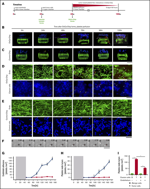 Platelet extravasation in the OvCa-Chip. (A) Time line describing the events and end points when endothelial cells, tumor cells, and platelets are introduced into the chip, followed by analysis of platelet extravasation. The tumor-endothelial coculture was established in the first 48 hours. Platelet perfusion was initiated at 48 hours, and the vascular alteration and subsequent platelet extravasation physiology was observed for up to 168 hours (7 days). Confocal micrographs showing 3D cross-sectional views of the OvCa-Chip consisting of cancer cells (blue, nuclei), vascular endothelial lumen (green, VE cadherin), and platelets (red, anti CD41) (B) and the Control-Chip consisting of control cells (blue), vascular endothelial lumen (green), and platelets (red) (C), every 24 hours after the platelets were introduced into the device. Bars represent 100 µm. (D) Confocal micrographs showing platelets (red) adhering to the vascular endothelium (Endo, green) and corresponding extravasation of platelets into the cancer cells (Cancer cells, blue) crossing the dysfunctional vascular barrier, at increasing time points when cancer cells were cocultured within OvCa-Chip. Bars represent 25 µm. (E) No prominent platelet adherence to the endothelial cells (Endo, green) and extravasation into control cells (Control cells, blue) was found in the Control-Chip. (F) After 72 hours, time-lapse images (brightfield and fluorescence overlaid; 10 minutes apart) taken within the tumor chamber showing platelets (red) extravasating from the luminal side (arrow) through the pore and entering into the cancer tissue compartment. Bar represents 25 µm. The quantitation of platelet adherence to the endothelium (G); extravasated platelet concentration observed within the tumor chamber (H) (●, OvCa-Chip; ▪, Control-Chip); and extravasated platelet concentration because of gain or loss of function of endothelial cells (I). Shaded area in panels G and H represents the 48-hour period before the introduction of platelets into the OvCa-Chip, when tumor-vessel coculture was established. Error bars indicate the mean ± SEM; n = 3 individual experiments. Two-tailed paired Student t test. *P < .05; **P < .01. ns, nonsignificant.