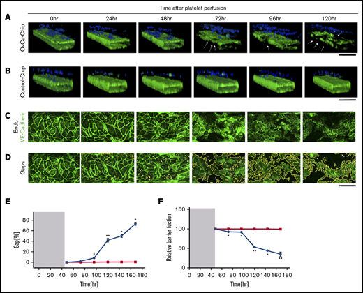Vascular degradation of the OvCa-Chip. Confocal micrographs showing 3D cross-sectional views of the OvCa-Chip, consisting of cancer cells (blue, nuclei) and vascular endothelial lumen (green, VE-cadherin) (A), and the Control-Chip, consisting of benign control cells (blue, nuclei) and vascular endothelial lumen (green, VE-cadherin) (B), imaged every 24 hours after cancer cells were introduced into the device. Arrows: degradation of endothelium and the gaps formed as a result. Bars represent 200 µm. High-resolution confocal micrographs of the vascular endothelial monolayer showing distinct loss of VE-cadherin (green) (C) and subsequent formation of gaps over time (identified in image processing) (D). Bars represent 25 µm. The distinct increase in vascular endothelial gaps (E), and the loss over time of vascular barrier function (F) in OvCa-Chips (●) relative to Control-Chips (▪). Shaded areas in panels E and F represent the 48-hour period when tumor-vessel coculture was established. Error bars indicate the mean ± SEM; n = 3 individual experiments. Two-tailed paired Student t test. *P < .05; **P < .01.