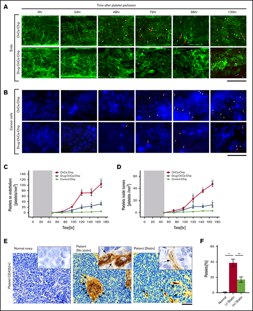 Platelet extravasation is arrested in the OvCa-Chip treated with atorvastatin. Confocal micrographs showing platelet (red) adhering to the vascular endothelium (Endo, green, VE-cadherin) (A), and corresponding extravasation of platelets into the cancer cells (cancer cells, blue, nuclei) (B) crossing the dysfunctional vascular barrier at increasing time points within OvCa-Chip (top) or OvCa-Chip treated with atorvastatin (Drug-OvCa-Chip; bottom). Bars represents 50 µm. Graph showing the quantitation of platelet adherence to the endothelium (C), and extravasated platelet concentration observed within the tumor chamber (D) (▪, OvCa-Chip; ▲, Drug-OvCa-Chip; and ●, Control-Chip). The shaded areas represent the 48-hour period before the introduction of platelets within OvCa-Chip when tumor-vessel coculture was established. P-values calculated vs Control-Chip; n = 3 individual experiments. (E) A representative immunohistochemical analysis of tumor tissue specimens obtained from healthy women and women with ovarian cancer showing platelets extravasated (CD42b+, brown, denoted by arrows) into the tumor stroma, in patients without statin drug treatment vs those with atorvastatin treatment. The bar represents 50 µm. Insets: original magnification ×40, of select regions. (F) Quantification of platelets observed with histology. Error bars are means ± SEM; n = 5 individual patient samples per group. One-way ANOVA, followed by Dunnett’s multiple-comparisons test. *P < .05; **P < .01.