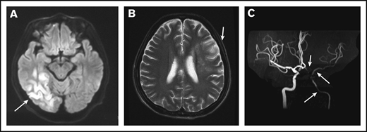 MRI and MRA for a patient with POEMS syndrome and IS. (A) MRI of the brain showed a cerebral infarction of the right temporal occipital lobe (white arrow). (B) A second MRI showed a new focal lesion of cerebral infarction near the left centrum semiovale 1 month later (white arrow). (C) MRA showed severe stenosis of the left intracranial internal carotid artery, left middle cerebral artery, and left anterior artery (white arrows).